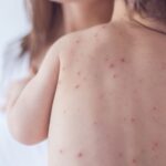 Эпидемия кори в США: катастрофический рост числа заболевших вызывает тревогу